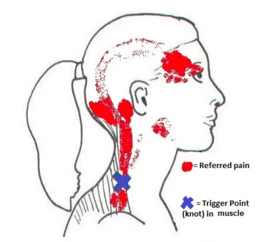 Migraines and Neck Pain: Finding Relief through Chiropractic Care