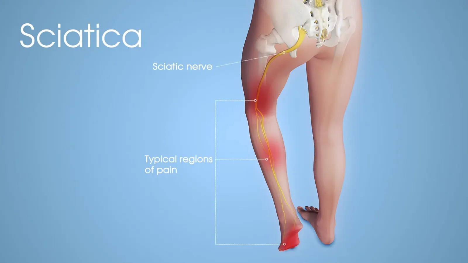 Illustration of the sciatic nerve running from the lower back down the leg, showing typical areas of sciatica pain