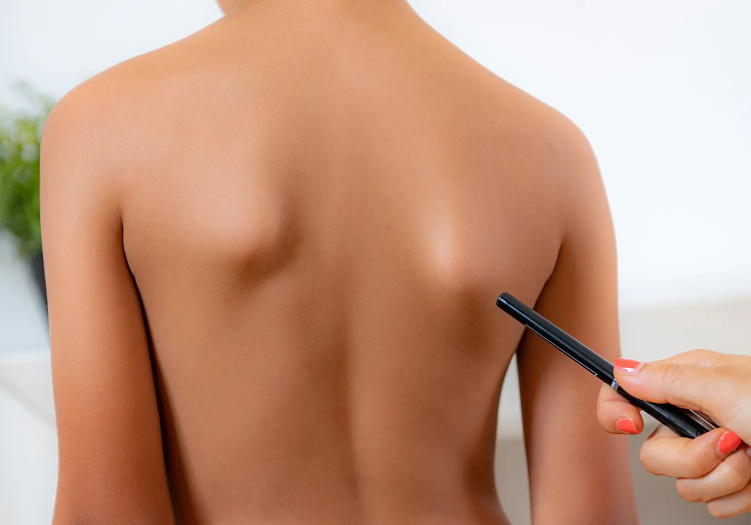What Do Dubuque Chiropractors Do to Treat Scoliosis?