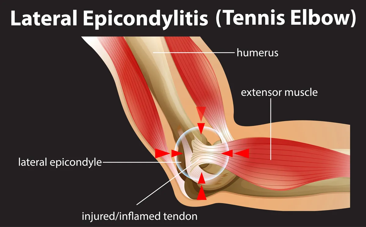 5 Signs Your Elbow Pain Is Actually Something Far Worse