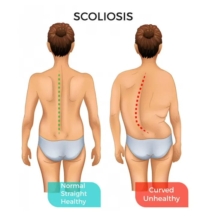The Different Types of Scoliosis & Their Common Causes