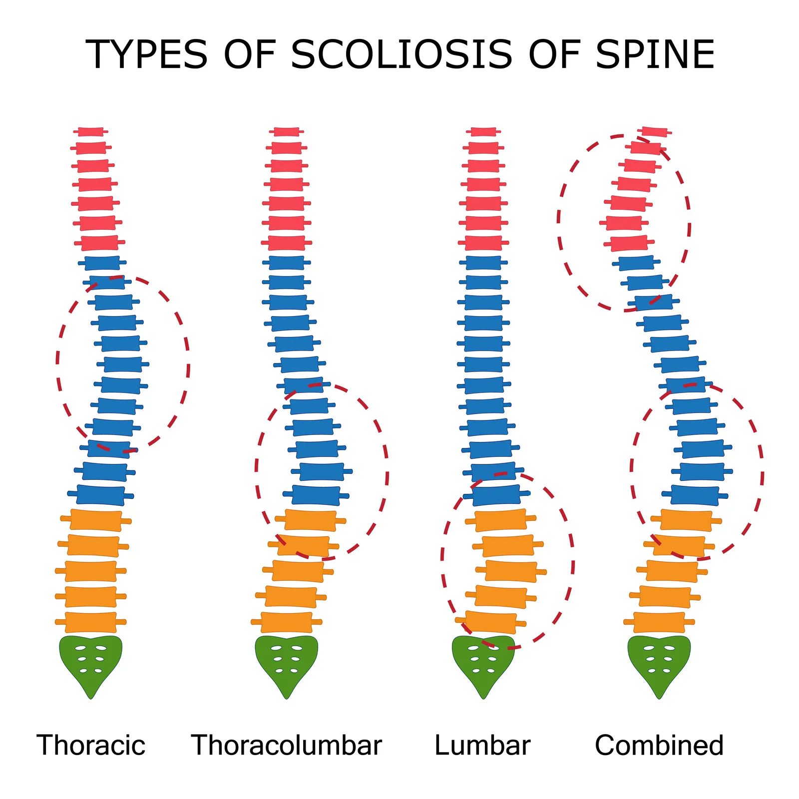 The Different Types of Scoliosis & Their Common Causes